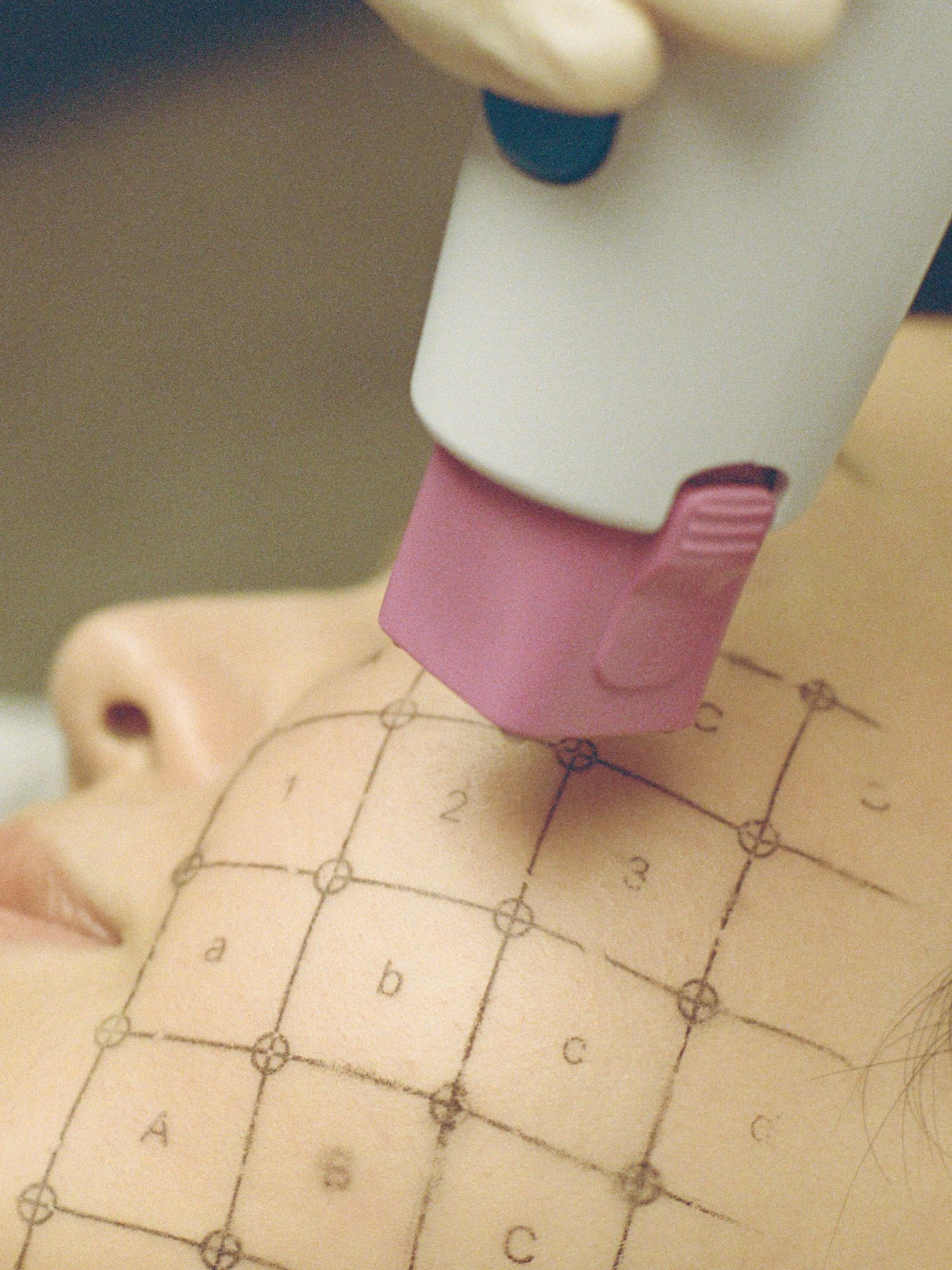 thermage 5