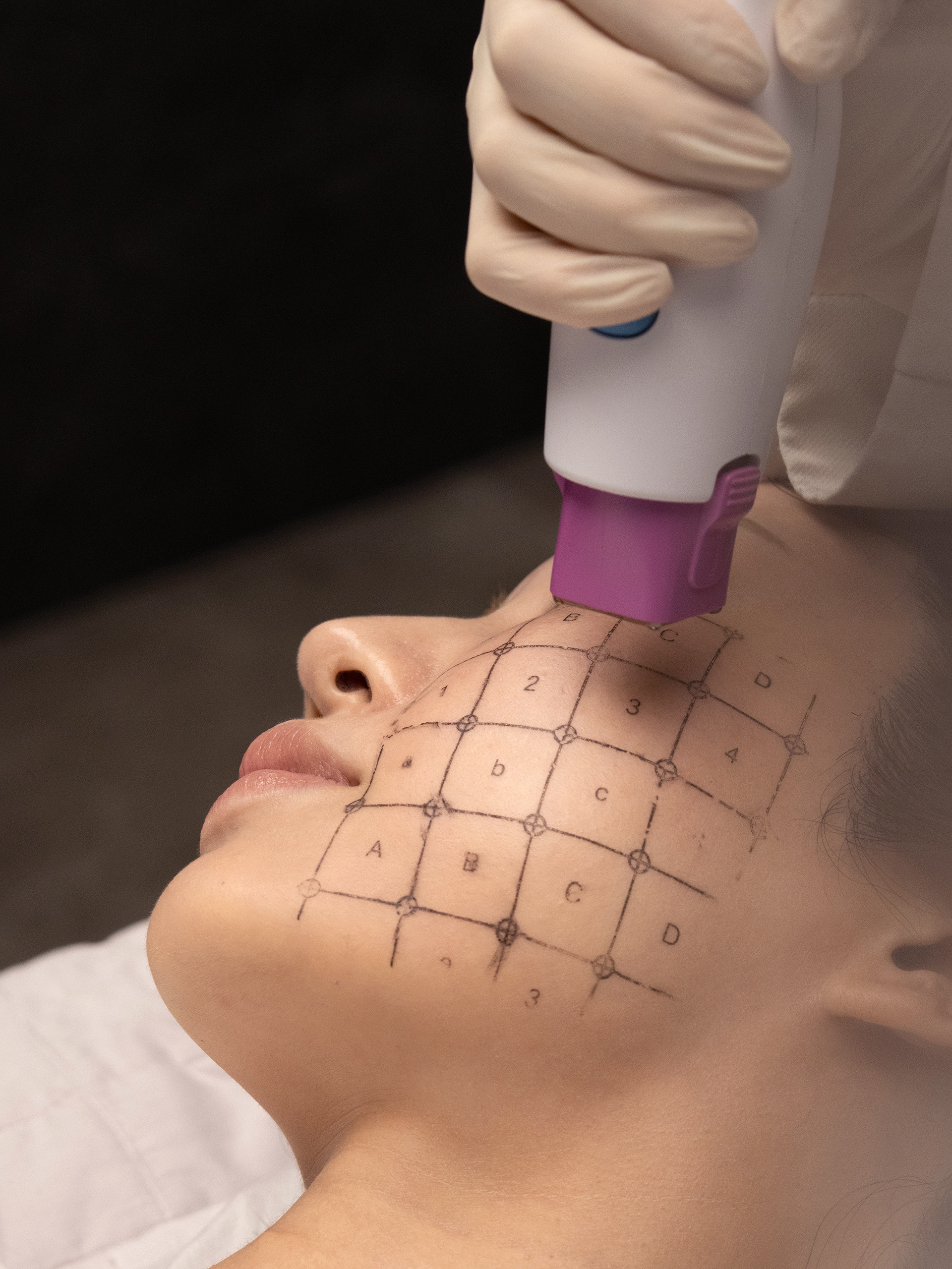 thermage 3