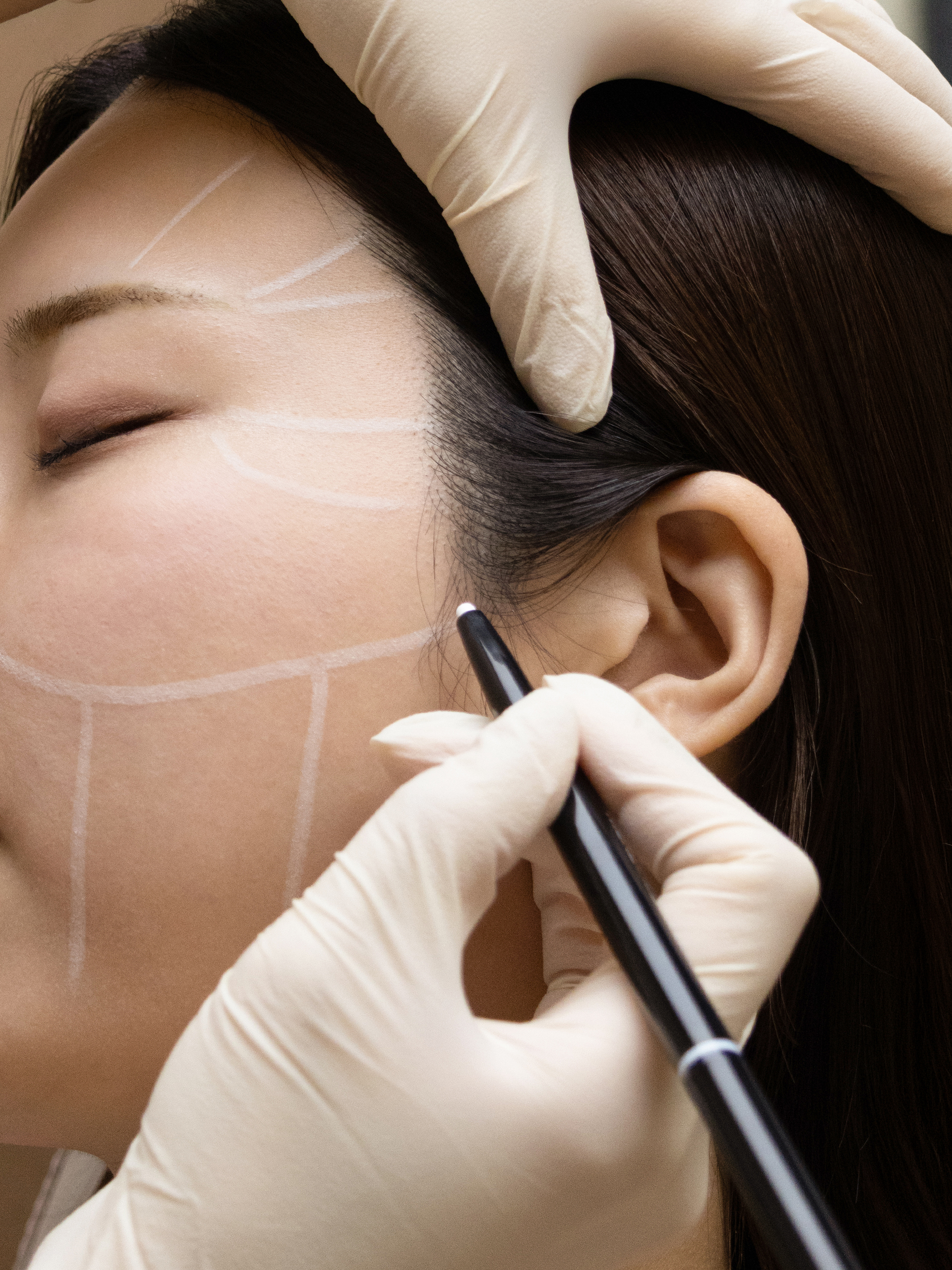 Ultherapy 07